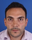 After Hair Transplant &nbsp;Front